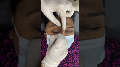 Sebaceous Cyst Removal Very Close To The Eye Follow On Insta