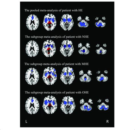 The Regions Of Decreased Blue And Increased Red Gray Matter