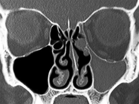 Endoscopic Nasal Surgery For Maxillary Atelectasis