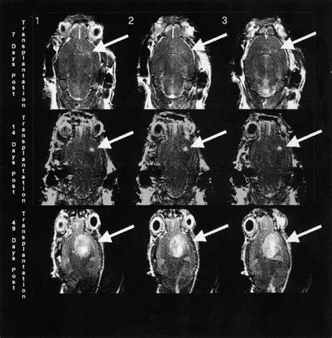 Micro MRI At 11 7 T Of A Murine Brain Tumor Model Using Delayed