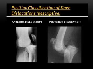 knee dislocation