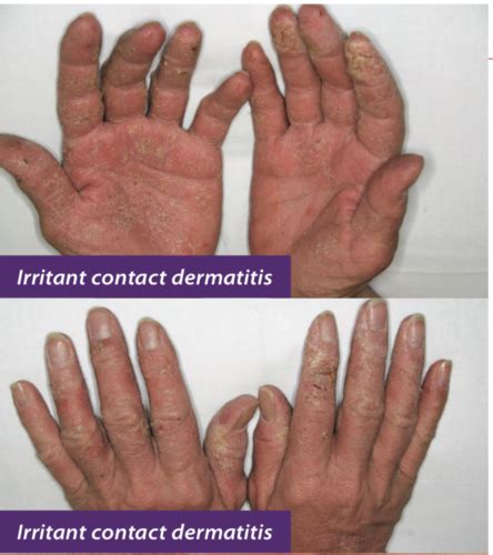 18 Irritant Contact Dermatitis Flashcards Quizlet