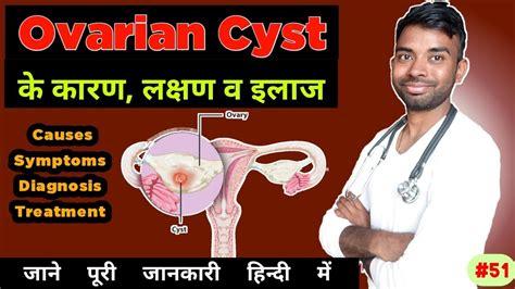 Ovarian Cyst Causes Symptoms Diagnosis And Treatment Passichamp