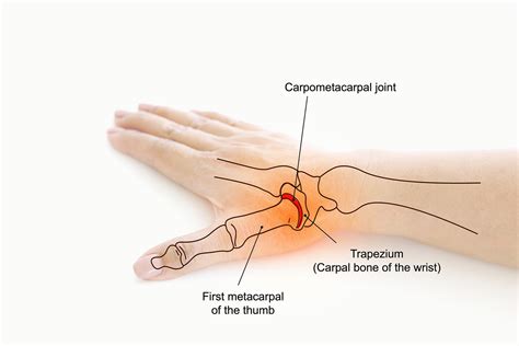 Pain, Swelling or Decreased Strength in Your Thumb? Learn about Thumb Arthritis. — Orthopedics ...