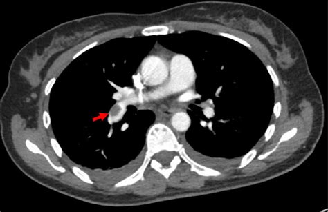 Ct Pulmonary Angiogram Demonstrating Embolus In The Right Lower Lobe Download Scientific