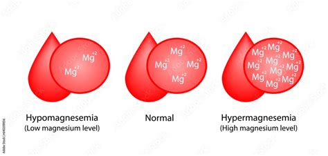 Hypermagnesemia High Plasma Magnesium Level And Hypomagnesemia Low Plasma Magnesium Level