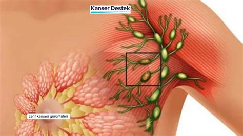 Lenf Kanseri G R Nt Leri Evre Ve Tedavisi