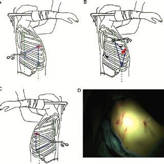 Videothoracoscopic Technique A Right Upper And Lower Lobectomy