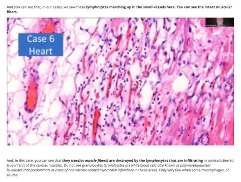 Dr Prof Arne Burkhardt S Slides Of Autopsies Of The Vaxxed