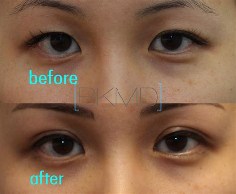 Asian Double Eyelid Surgery Blepharoplasty Nyc Dr Brett Kotlus