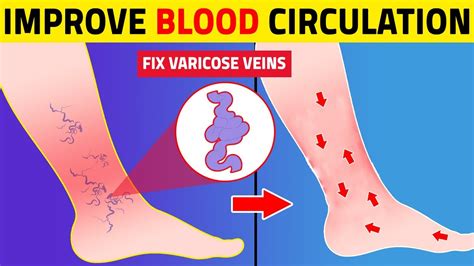 Varicose Veins 8 Tips For Improving Leg Circulation Youtube