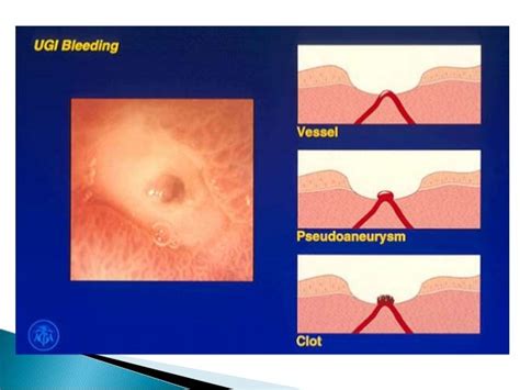 Approach To Patients With Upper Gi Bleeding