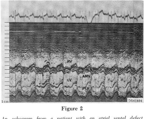 Figure From Echocardiographic Manifestations Of Left Bundle Branch