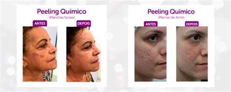 Peeling Químico O Que é Benefícios E Cuidados Após O Tratamento Pró