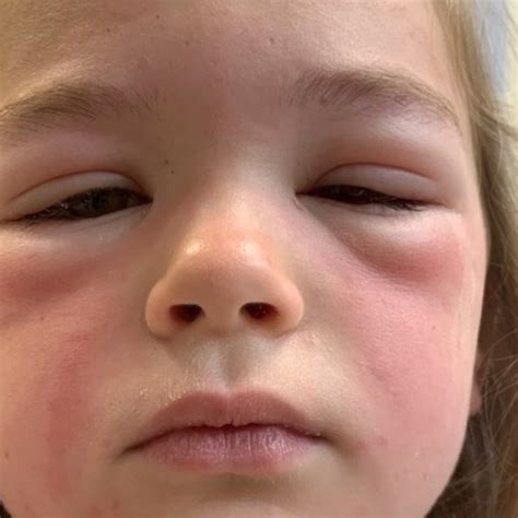 Girl Suffers Severe Allergic Reaction To Caterpillar Prompting Warning The Cairns Post