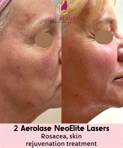 Aerolase Neo Elite Mississauga On Luxe Beauty And Wellness Spa