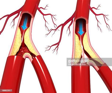 Aortic Atherosclerosis High Res Illustrations - Getty Images