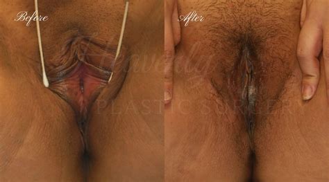 Labiaplasty Gallery Heavenly Plastic Surgery