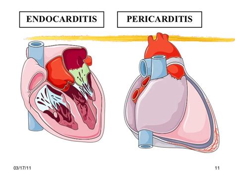 14 Pericarditis And Endocarditis And Valvular Heart Disease 네이버 블로그