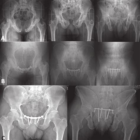 Tile B1 Prf In A Patient Of Group 1 A Preoperative X Rays B Download Scientific Diagram