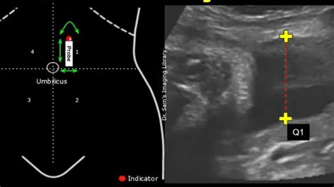 Amniotic Fluid Index Obstetricsandgynecology Youtube