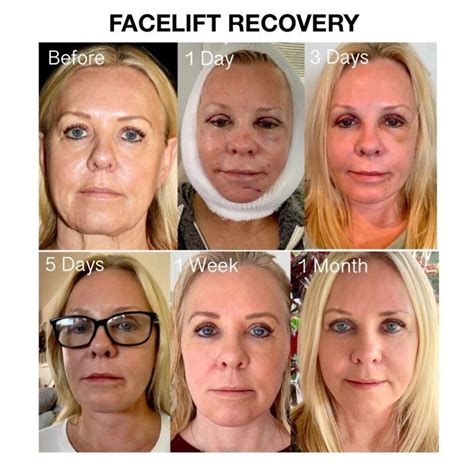 Laser Face Lift Recovery Time At Fannielnealo Blog