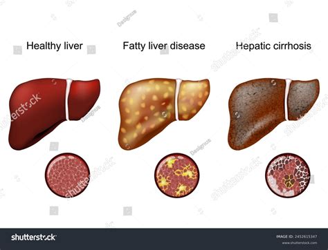 Fatty Liver Disease Hepatic Cirrhosis Close-up Stock Vector (Royalty ...