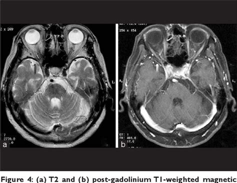 Pdf Pontine Venous Congestion Due To Dural Arteriovenous Fistula Of