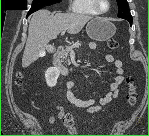 Vascular Metastases To The Liver Bone And Muscle From Renal Cell