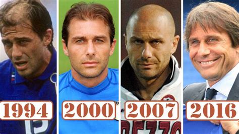 Antonio Conte Hair Transplant Story Cliniqueplus