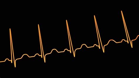 Detailed Illustration Electrocardiogram Displaying Sinus Bradycardia