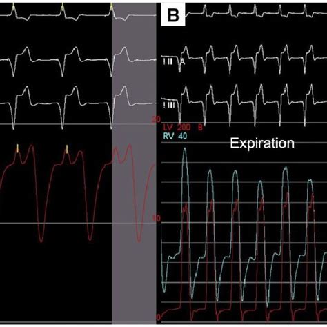 Haemodynamic tracings before epicardial pacemaker leads removal. Right ...