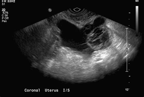 Endometrioma Ultrasound