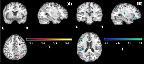 Statistical Parametric Map Of Patient A Positive Bold Or