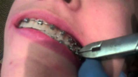 Hess Orthodontics Demonstrates How To Fix A Poking Wire On Braces In