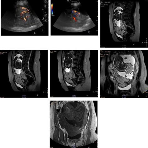 Pdf Placenta Previa Mri As An Adjunct To Ultrasound In Assessment Of Suspected Placental Invasion