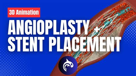 Angioplasty And Stent Placement 3d Animation Youtube