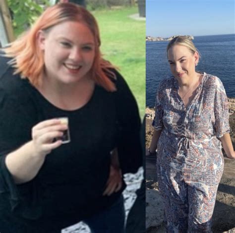 Maisies Story Streamline Weight Loss Surgery