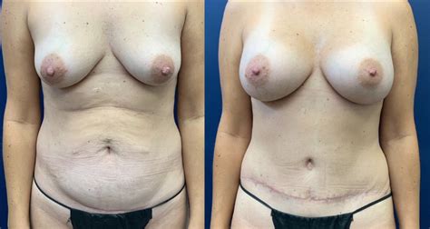 Patient Breast Augmentation Before After Photos Dr Butler