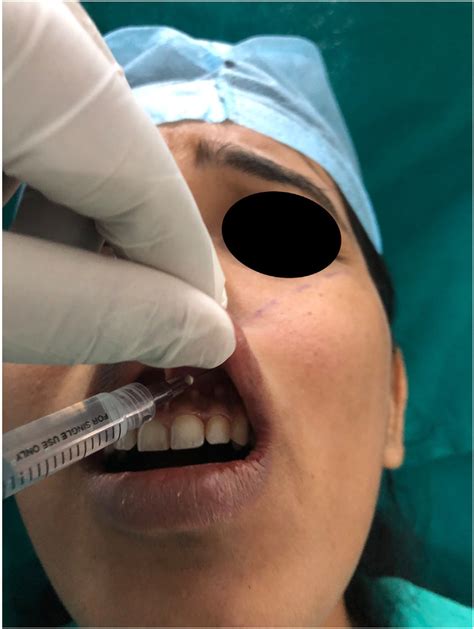 Demonstrates The Intra Oral Infra Orbital Technique Using The Alar Base