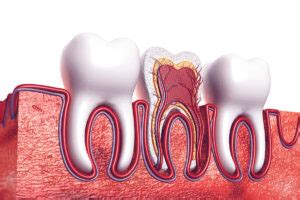 Root Canal Recovery Time – Be Impressed With Your Body’s Ability to ...