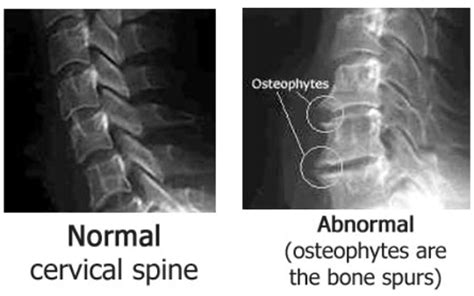 Osteophytes Treatment