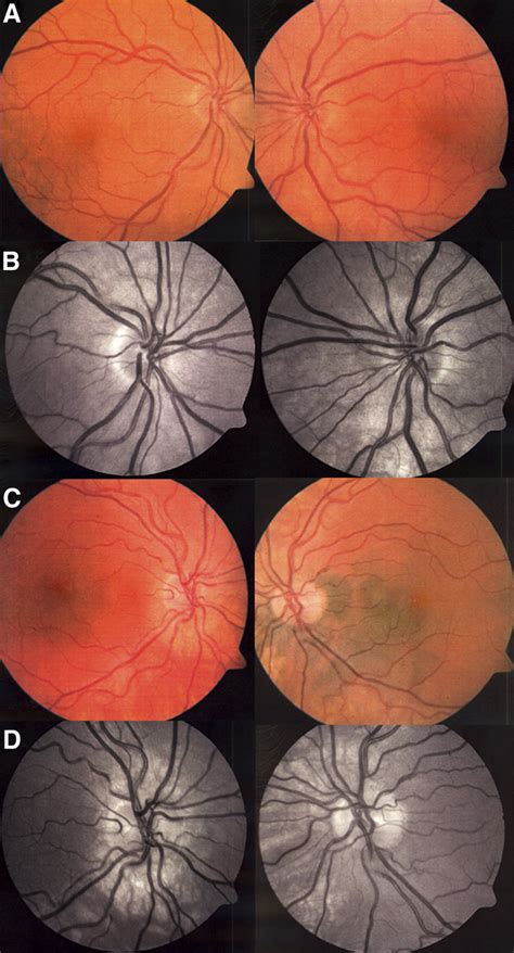 Optic Disks Of Individuals Ii3 And Iii5 Fundus Photos In Color A