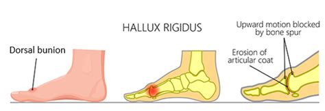 Hallux Rigidus Stiff Big Toe Joint Treatment Flint Foot And Ankle