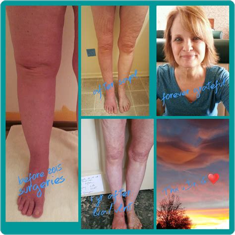 List Pictures Pictures Of Lymphedema In The Legs Updated