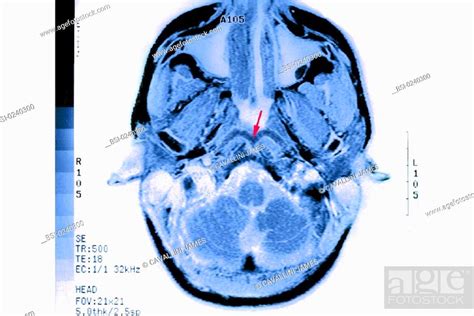 TONSIL, SCAN Tonsils, indicated by arrow, Stock Photo, Picture And Rights Managed Image. Pic ...