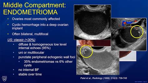 Endometriosis Diagnosis Staging And Reporting Youtube