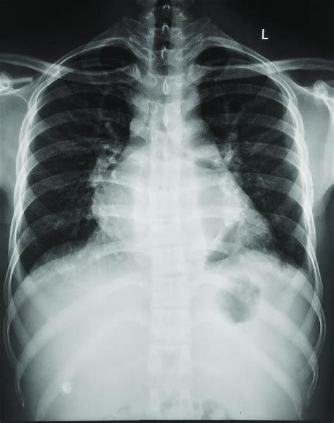 Chest X Ray Posteroanterior View Download Scientific Diagram