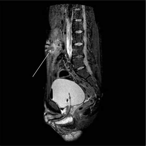 Pdf Infected Urachal Cyst In An Adult A Case Report And Review Of