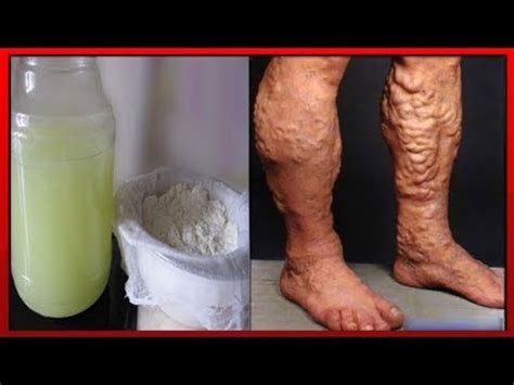 Избавитесь от ТРОФИЧЕСКИХ ЯЗВ , от ВАРИКОЗА и ГЕЛЬМИНТОВ используя ...